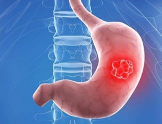 你知道嗎？從慢性胃炎到胃癌，只有四步！